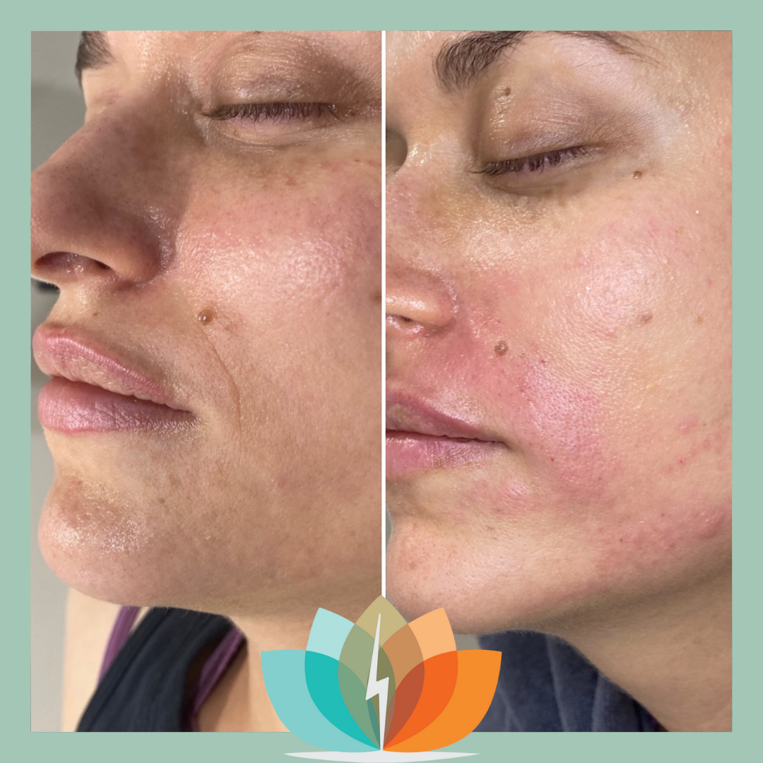 An image of a woman who has gotten a PRP facial.